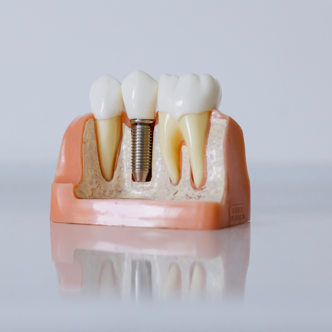 Dental Crowns in Mississauga | General Dental Services | Cooksville Dental 