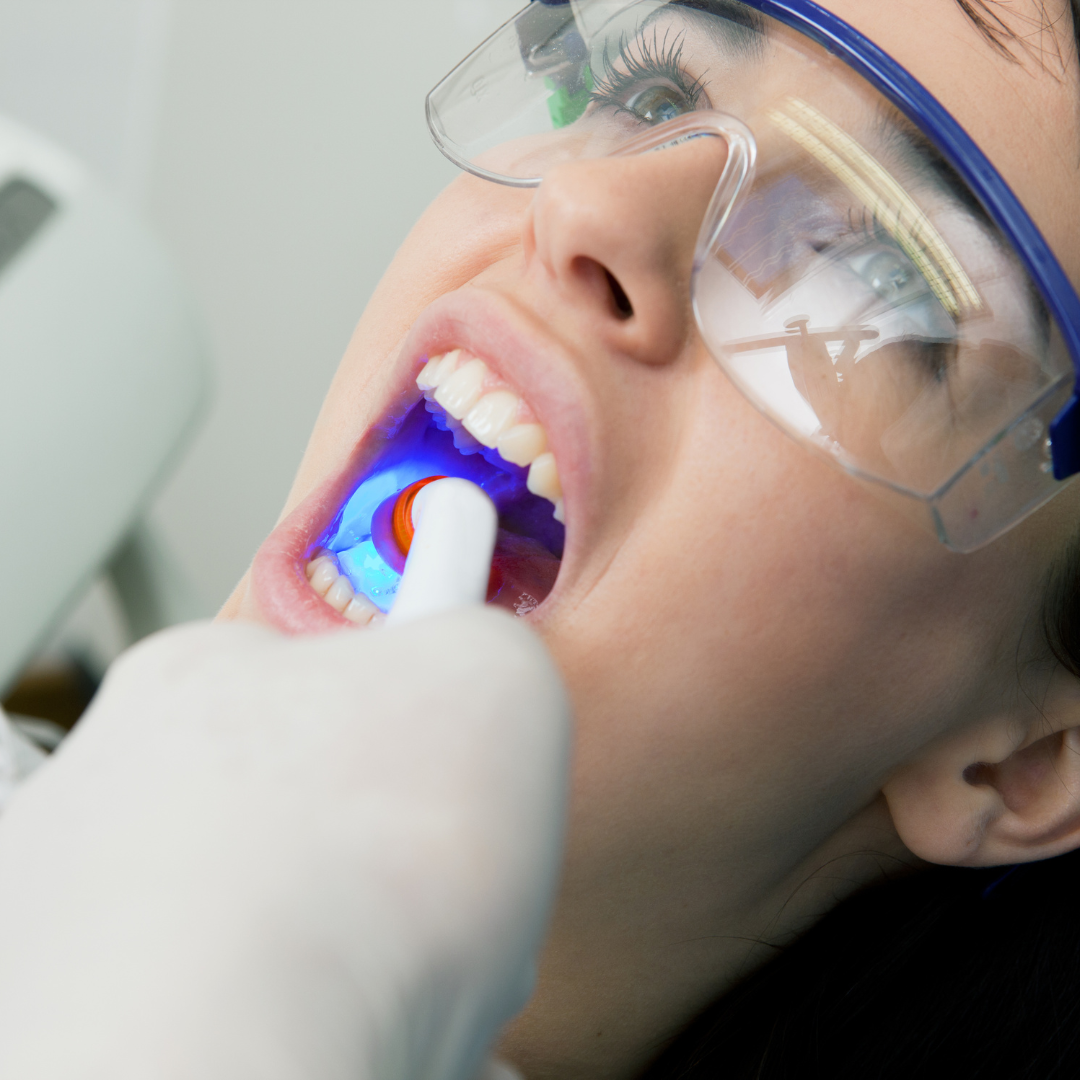 Dental Bonding in Mississauga | General Dental Services | Cooksville Dental
