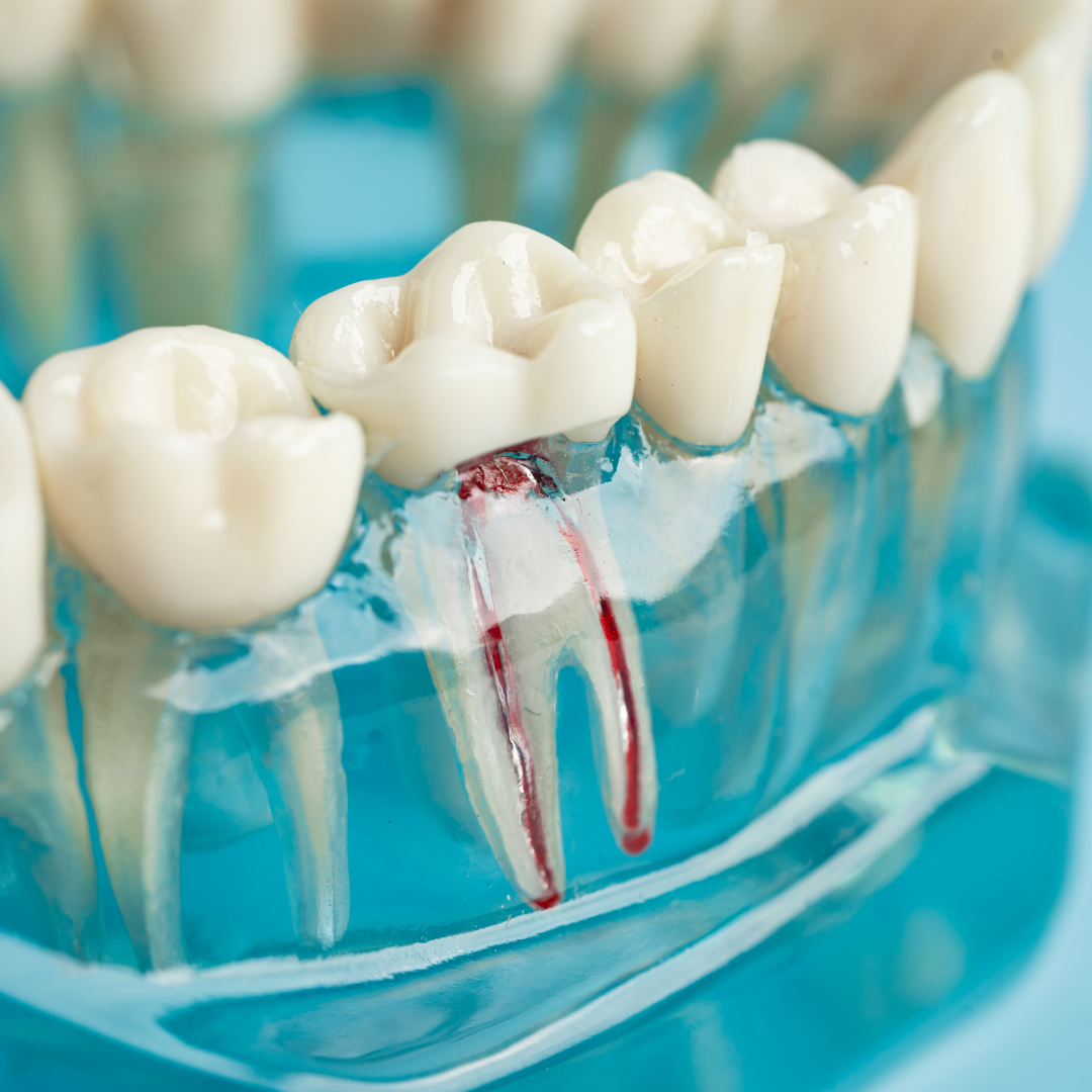 Root Canal Treatment in Mississauga | General Dental Services | Cooksville Dental